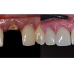 Sofortimplantation und Sofortversorgung - vom Einzelzahn bis zum zahnlosen Kiefer