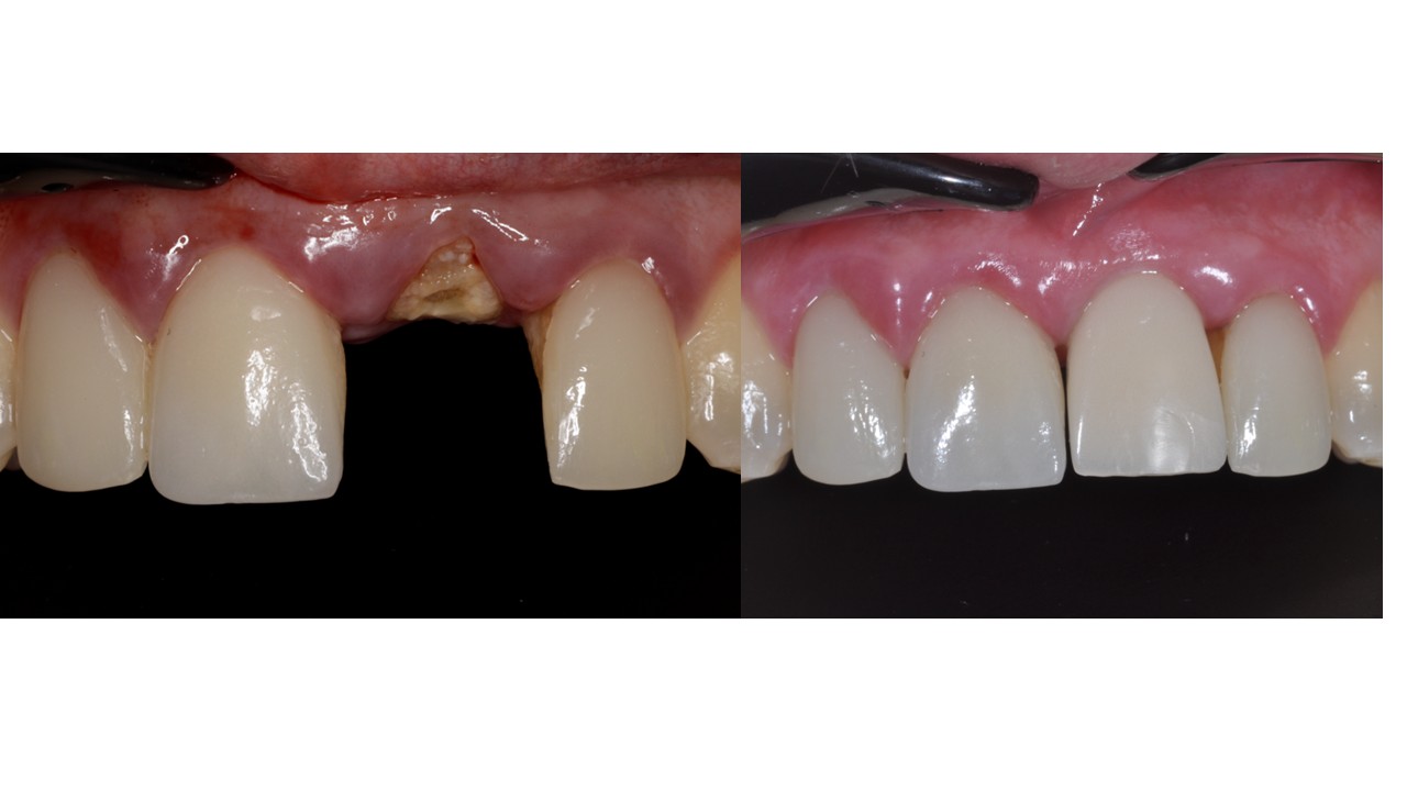Sofortimplantation und Sofortversorgung - vom Einzelzahn bis zum zahnlosen Kiefer