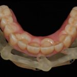 Implantatprothetik beim zahnlosen Patienten